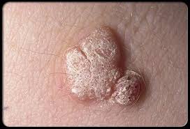 Image result for verrucae filiformes