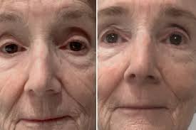 Put to the test: a laser that remodels your skin by targeting wrinkles,  scars and acne, we're told