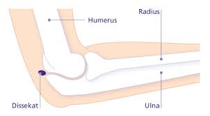 Welche arten von ellenbogenschmerzen gibt es? Freier Gelenkkorper Im Ellenbogen Osteochondrosis Dissecans Gelenk Klinik De