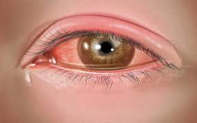 Image result for Viral Conjunctivitis