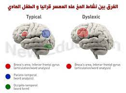 The chronically sick and disabled persons act makes passing reference to dyslexia. Ù…Ø§ Ù‡Ùˆ Ø¹Ø³Ø± Ø§Ù„Ù‚Ø±Ø§Ø¡Ø© Ø§Ù„Ø¯ÙŠØ³Ù„ÙƒØ³ÙŠØ§ Ù…Ø¸Ø§Ù‡Ø±Ù‡ Ø£Ø³Ø¨Ø§Ø¨Ù‡ Ùˆ Ø¹Ù„Ø§Ø¬Ù‡ ØªØ¹Ù„ÙŠÙ… Ø¬Ø¯ÙŠØ¯