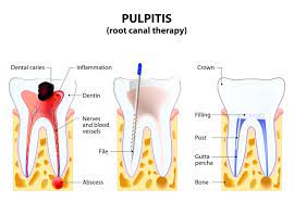 Recognize The Symptoms Of Failed Root Canal Smile Angels Of Beverly Hills