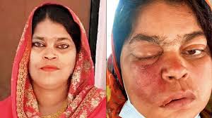 Mucormycosis, also known as black fungus, is a rare but dangerous infection. Mumbai Covid 19 Negative Woman Dies Of Black Fungus Despite Right Surgery