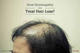 They can then prescribe the appropriate homeopathic medication to the individual. How Homeopathy Can Treat Hair Loss By Dr Swapan Debnath Lybrate