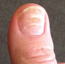 This disruption is usually caused by some kind of illness. Beau S Lines Wikipedia