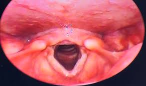 Image result for Reflux Laryngitis