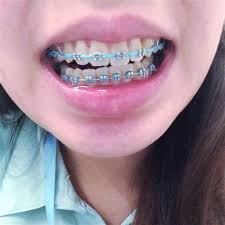 Black And Light Blue Braces Blue Power Chain Braces Google Search Power Chain Braces Braces Tips Braces