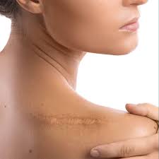 Of all types of skin cancer, melanoma causes the most deaths because of its tendency to spread to other parts of the body, including vital organs. Keeping Up Appearances Minimizing Scarring After Skin Cancer Surgery