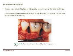 Periodontitis is the most common cause of dental bone loss and this condition cannot be reversed. 024 Bone Loss And Patterns Of Bone Destruction