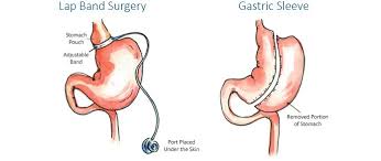 Gastric band bariatric surgery turkey faq's. Difference Between Gastric Sleeve And Lap Band Surgery Cedars Sinai Marina Del Rey Hospital