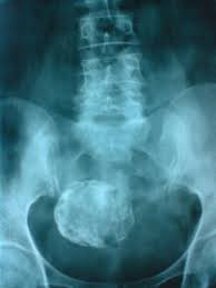 Fibroid ini kebetulan dijumpai semasa prosedur imbasan bunyi dijalankan bagi tujuan lain. Ramai Wanita Tak Tahu Ada Fibroid Harian Metro