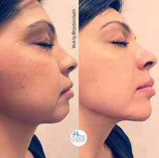 Having a shizzled jawline & chin just became so much easier. Our Nurse used  2 syringes of Voluma to fill this patients' jaw & chin & give her that  beautiful projection. Each