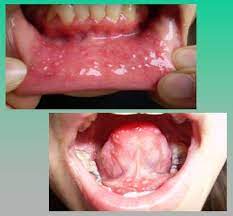 Un absceso dental es un término común usado para describir una infección en la raíz de un diente o entre un diente y las encías.por lo general es causada por. Aftas Orales Recurrentes Diagnostico Diferencial Y Manejo Medwave