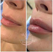 Il y a 2 avis sur le produit (formation hyaluron pen). Soin Hyaluron Pen Et Centre De Formation Aesthetic Expert Marseille