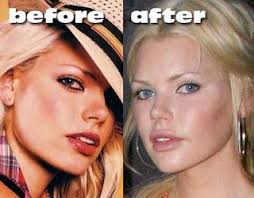 Celebrity Plastic Surgery Photos