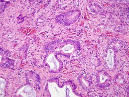 Those who recover from stage 1a lung cancer with no vascular invasion, which means the tumor was very small and had not extended into any blood vessels or lymph nodes before going into remission. Non Small Cell Lung Cancer Cancer Therapy Advisor