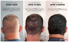 It is usually the miniaturized hair (i.e. What Is Shock Hair Loss Hair Transplant In Turkey