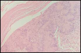 The remainder are associated with neurofibromatosis 2 (3%), schwannomatosis (2%), or multiple meningiomas with or without nf2 (5%). Histoquarterly Schwannoma Histology Blog