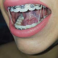 Braces Girlswithbraces Metalbraces Elastics Dental Braces Braces Girls Cute Braces