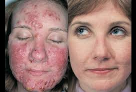Jul 31, 2020 · pictures. Acne Vulgaris Nodulocystic Picture Image On Medicinenet Com
