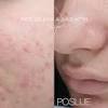 Ona se koristi u profesionalnim dermatološkim i. 1