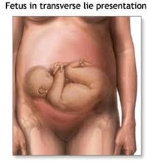 I'm a pediatric sleep specialist who has seen it all, and i'm here to tell you that it's caring for a baby with a wet or dry cough? Transverse Lie Baby Is Sideways Babycenter