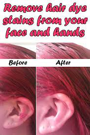 Remove Hair Dye Stains From Your Face And Hands Hair Dye Removal Dyed Hair Henna Hair