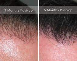 At seven months this is what it's supposed to look like with relatively fine hair, and i would guess it'll be 30 or 40 or 50 percent better at a year and a month. Hair Transplant Post Op Care Hair Restoration Kansas City Des Moines