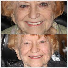 Happy Thursday WDA! Wanted to share a recent smile transformation done by  Dr. Aldrich and the awesome WDA team. This beautiful patient had over 20  units of crown and bridge work done