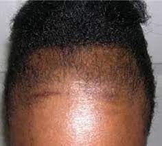 Pin By Natural Haircare News On Natural Haircare News Blogs Black Women Hair Loss Thinning Hairline Protective Hairstyles Braids