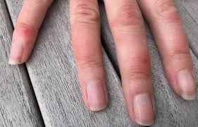 Cette sciatique du bras est une complication des douleurs cervicales, qui sont très fréquentes et qui Coronavirus Pseudo Gelures Irritations Aux Mains Et Aux Pieds De Nouveaux Symptomes Du Covid 19