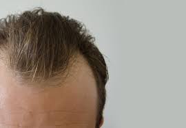 We come to you for any occasion !!!!! Hair Transplant Chicago Il Chicago Hair Institute