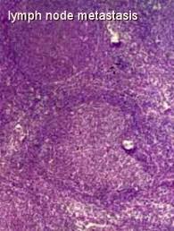 How breast cancer is diagnosed? Breast Cancer Metastasis Survival Rates For Stage Iv