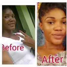 Where Can I Find Permanent Skin Lightening Surgery In The Usa Quora Skin Lightening Cream Natural Skin Lightening Organic Skin Lightening