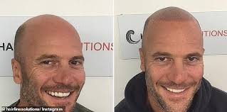 Instead, micro scalp pigmentation is a procedure that involves tattooing the head with tiny dots to give the appearance of short hair follicles. Balding Men Are Flocking To Get Their Heads Tattooed After Mike Gunner Revealed Hair Hack Daily Mail Online