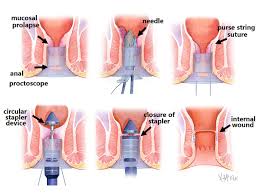 Laparoscopic surgery can provide a method for reconstruction of the pelvic floor and its contents without the need for a large abdominal incision. Rectal Prolapse Colorectal Surgeons Sydney
