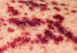 While bateman's is common, it is not dangerous. Bruises Causes Colors And Treatments