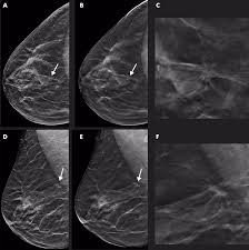 Mammograms may show suspicious areas of the breast, white spots, and microcalcifications. Dbt Helps In Early Detection Of Breast Cancer Compared To Mammography Study