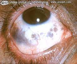 تُعدّ العدسة من أهم أجزاء العين؛ إذ تنكسر فيها أشعة الضوء التي تدخل إلى العين لتُساعد في توفير الرؤية. Atlas Of Ophthalmology