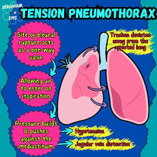Image result for Open Pneumothorax