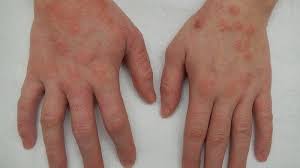Ade tak yang macam ni? Mengenal Dermatitis Peradangan Yang Membuat Kulit Kering Bengkak Merah Hingga Gatal Tribun Jogja