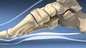 Cotton Osteotomy (Medial Cuneiform Opening Wedge Osteotomy)