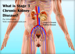 At this relatively early stage, you do not need dialysis or a kidney transplant. Signs Of Stage 3 Chronic Kidney Disease How Can Diet Help With Stage 3 Chronic Kidney Disease