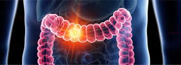 Image result for Colorectal Cancer