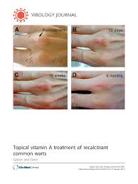 Acitretin in individual case reports and intralesional candida antigen have shown promising efficacy in the treatment of recalcitrant warts; Topical Vitamin A Treatment Of Recalcitrant Common Warts Topic Of Research Paper In Clinical Medicine Download Scholarly Article Pdf And Read For Free On Cyberleninka Open Science Hub