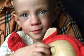 Tiny premature baby with skin so thin she was kept in a 'bag' defies odds  of survival