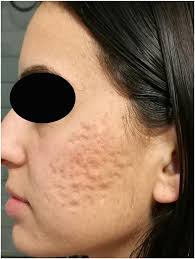 Energy-based devices for the treatment of Acne Scars: 2022 International  consensus recommendations