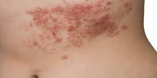 Maybe you would like to learn more about one of these? Doctors Ø§Ù„Ø­Ø²Ø§Ù… Ø§Ù„Ù†Ø§Ø±ÙŠ Zoster Ù‡Ùˆ Ø§Ù„ØªÙ‡Ø§Ø¨ ÙÙŠØ±ÙˆØ³ÙŠ ÙŠØ³Ø¨Ø¨ Ø·ÙØ­ Ø¬Ù„Ø¯ÙŠ ÙˆØªÙ‡ÙŠØ¬ Ù…Ø¤Ù„Ù… Ù„Ù„Ù…Ù†Ø·Ù‚Ø© Ø§Ù„Ù…ØµØ§Ø¨Ø© ØªØ­Ø¯Ø« Ø§Ù„Ø§ØµØ§Ø¨Ø© ÙÙŠ Ø§ÙŠ Ù…Ù†Ø·Ù‚Ø© Ù…Ù† Ø§Ù„Ø¬Ø³Ù… ÙˆØ¹Ø§Ø¯Ø© ÙŠØ¸Ù‡Ø±Ø¹Ù„Ù‰ Ø´ÙƒÙ„ Ø®Ø· ÙŠÙ„ØªÙ Ø­ÙˆÙ„ Ø§Ù„Ø¬Ù‡Ø© Ø§Ù„ÙŠÙ…Ù†Ù‰ ÙˆØ§Ù„ÙŠØ³Ø±Ù‰ Ù…Ù†