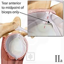 Image result for SLAP Lesion