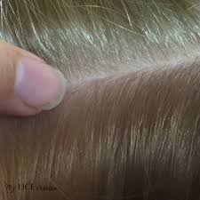 Salon near me feature also helps in searching for salons on the basis of distance, price and other filters. Lice In Blonde Hair Lice Eggs Pictures And Unique Challenges